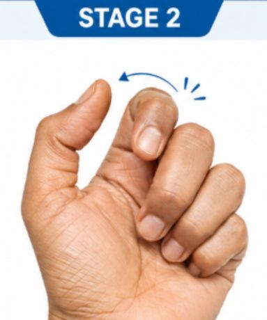  Hand showing clicking and catching symptoms of trigger finger