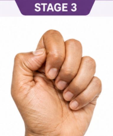  Hand showing finger locking and reduced movement in advanced trigger finger